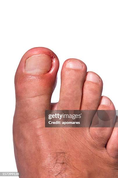 ingrown toenail - toenail stock pictures, royalty-free photos & images