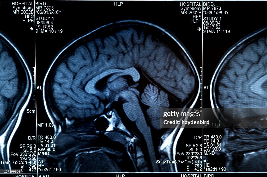 MRI Scan mit Gehirn mehrere Bilder von Kopf und Totenkopf