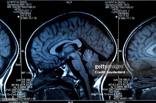 cerveau montrant scanner à résonance magnétique plusieurs images de la tête et du crâne - cervelet photos et images de collection