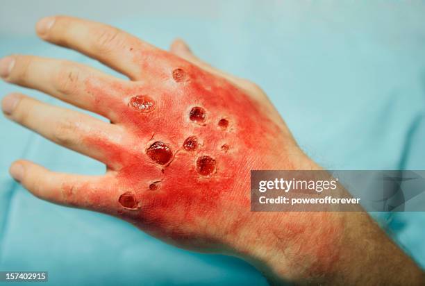 second degree burn to hand - hand laceration stockfoto's en -beelden