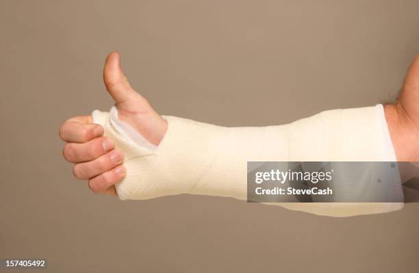 mans arm in cast - plaster stock pictures, royalty-free photos & images