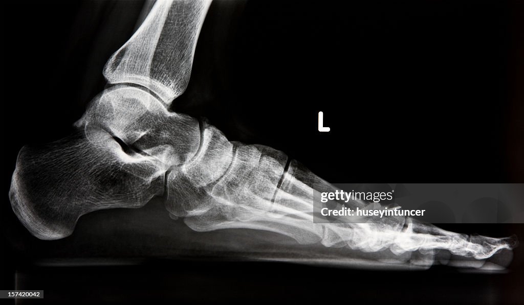 X-ray of human foot