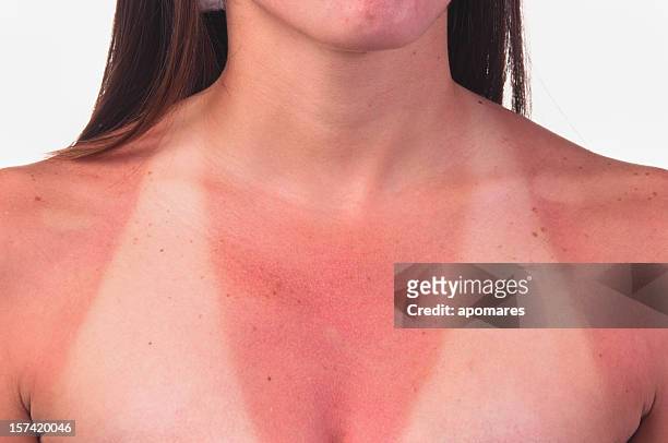 unter sonnenbrand zu lindern - sunburn stock-fotos und bilder