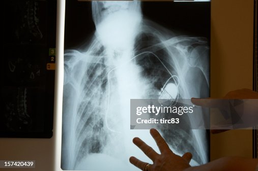 Hands examining pacemaker x-ray Hands examining pacemaker x-ray