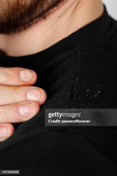 caspa - dandruff fotografías e imágenes de stock