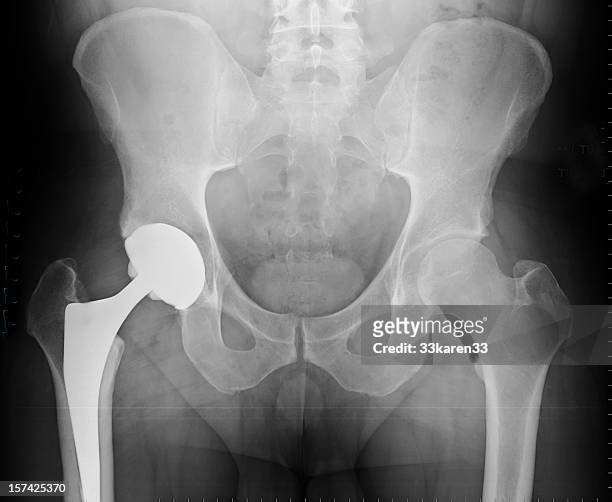 x-ray of total hip arthroplasty - hips stock pictures, royalty-free photos & images