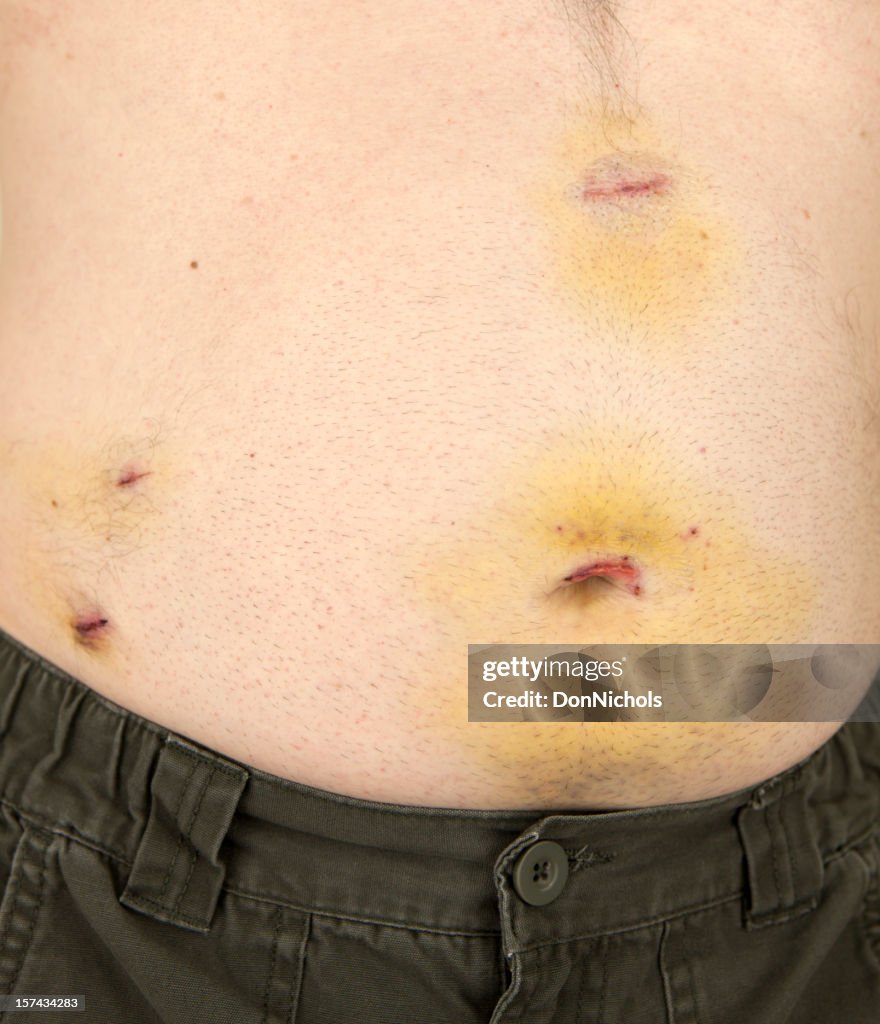 Laparoscopic Gall Bladder Surgery Scars