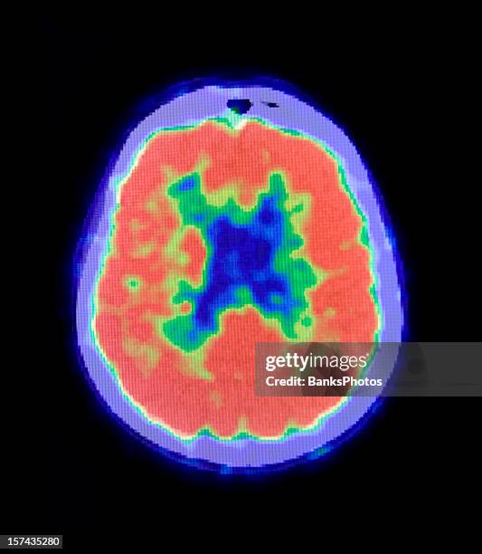 menschliche gehirn pet-scan - x ray image stock-fotos und bilder