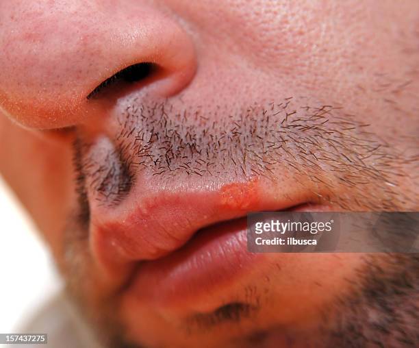 herpes labialis, cold sore or fever blister - cold sore stock pictures, royalty-free photos & images
