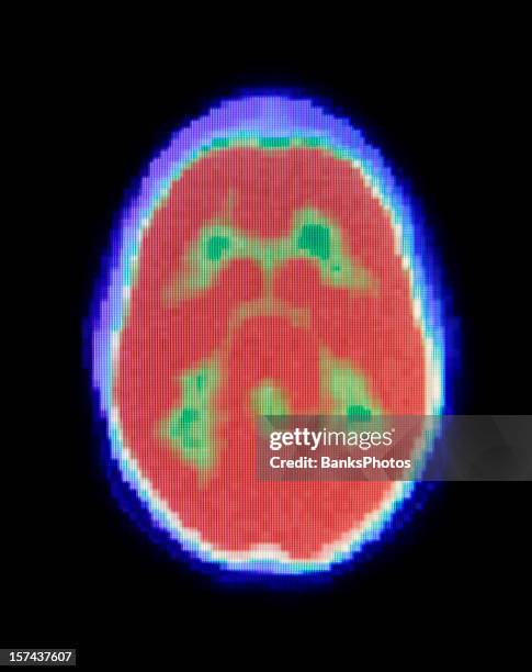 cerveau humain tomographie par émission de positrons - tomographie par émission de positrons photos et images de collection