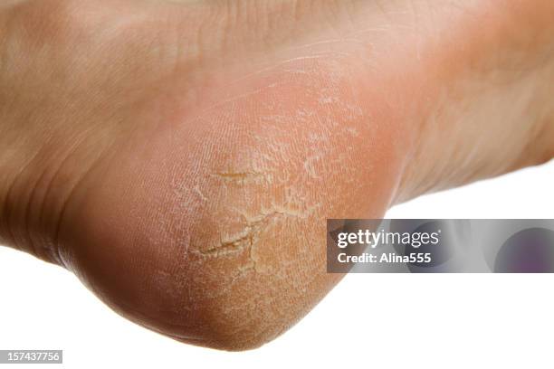 dry and cracked woman's heel on white background - dry skin stock pictures, royalty-free photos & images