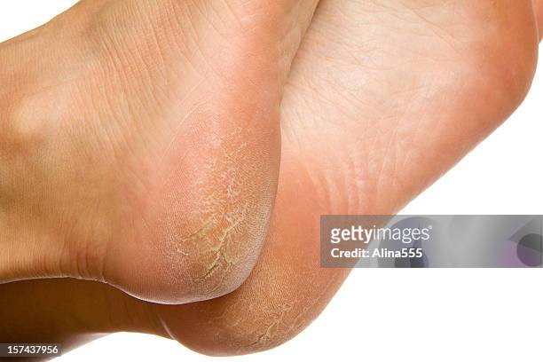 dry and cracked soles of feet on white background - female feet soles stockfoto's en -beelden