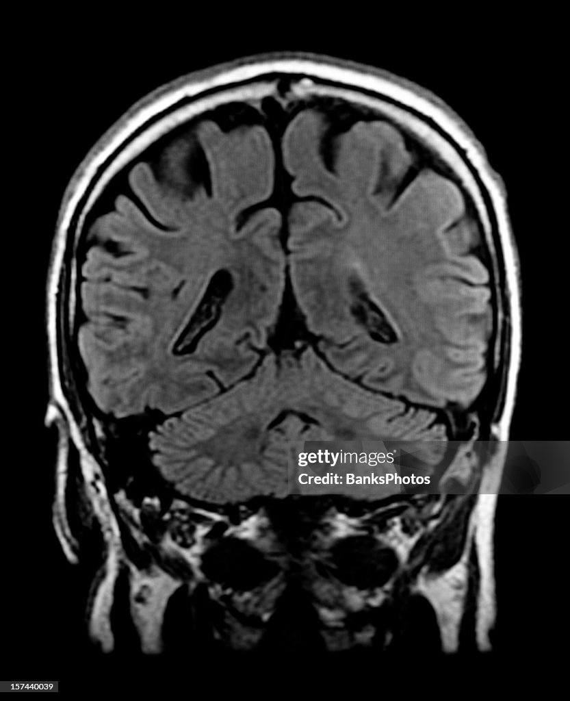 Head MRI Scan of Brain with Visible Cerebellum