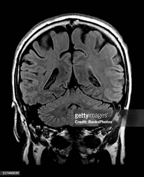 head mri scan of brain with visible cerebellum - skull xray no brain stock pictures, royalty-free photos & images