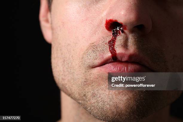 nose bleed - nose stock pictures, royalty-free photos & images