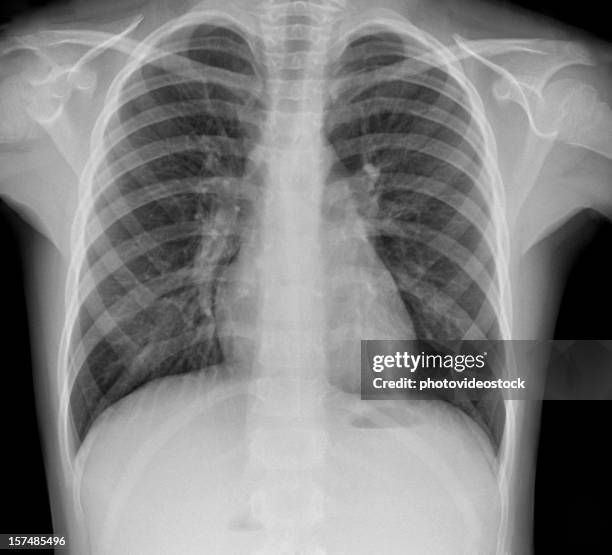 pneumonia x-ray - human rib cage stock pictures, royalty-free photos & images