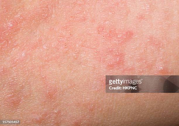 red skin rash with bumps, scabs & pimples on child - dry stockfoto's en -beelden
