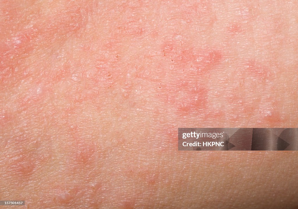 Red Skin Rash With Bumps, Scabs & Pimples On Child