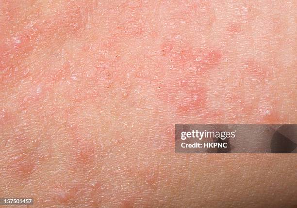 red skin rash with bumps, scabs & pimples on child - människohud bildbanksfoton och bilder