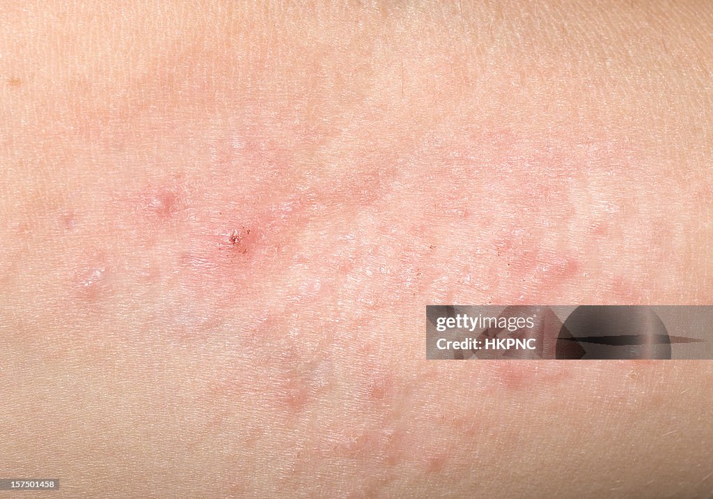 Red Skin Rash With Bumps, Scabs & Pimples On Child
