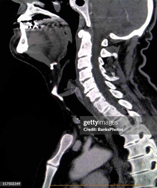 ct scan de la colonne cervicale - ct neck photos et images de collection