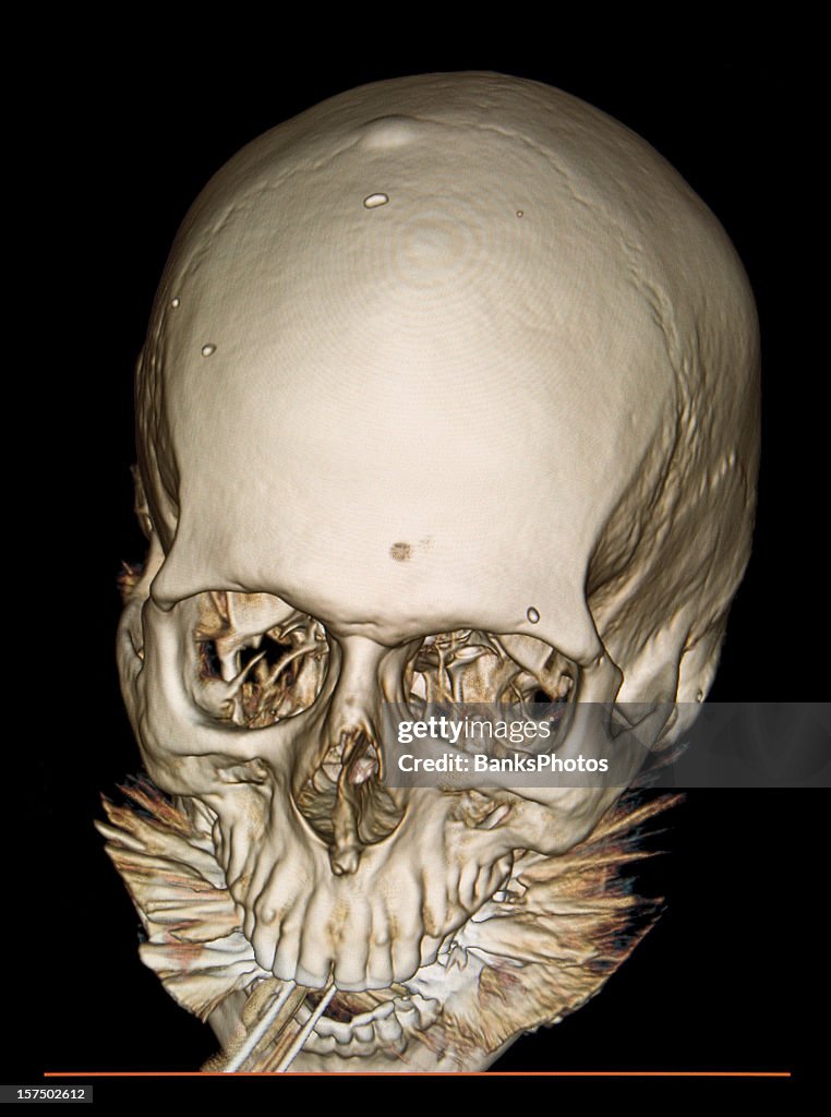 3D Skull Front View CAT Scan