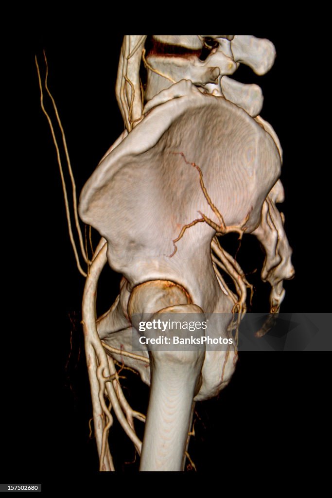 Lateral Scan 3d Lateral Ct Scan Of Pelvis With Arteries High-Res Stock Photo - Getty ...