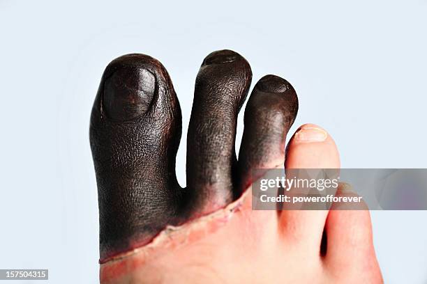 third degree frostbite to toes - grotesque stock pictures, royalty-free photos & images