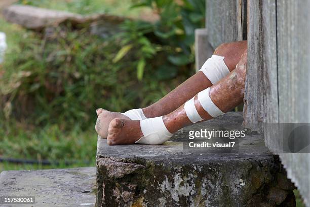 feet of a leper - leprosy stockfoto's en -beelden