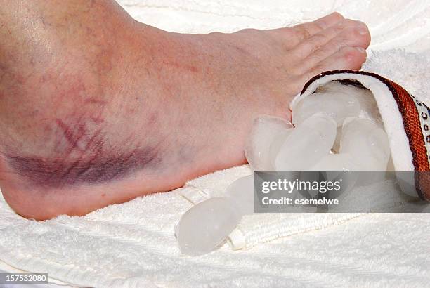 sprained ankle - ijszak stockfoto's en -beelden