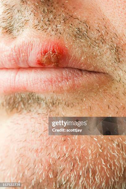 cold sore on the lip of a middle aged male. - cold sore stock pictures, royalty-free photos & images