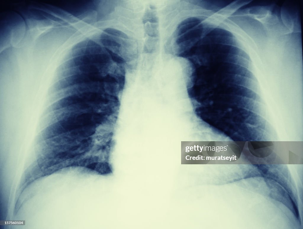 Lung x-ray of a pneumonic patien