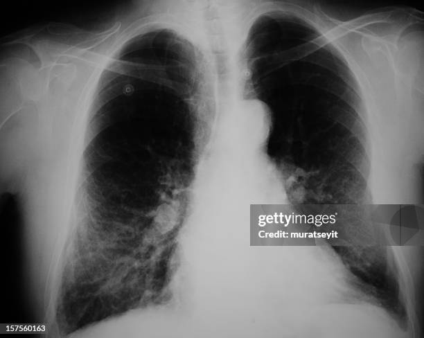 pneumonia - bronchialbaum stock-fotos und bilder