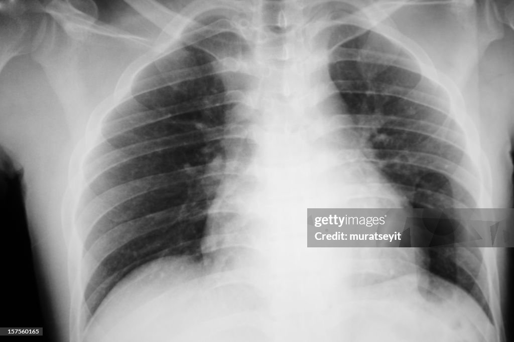 X-ray of a smoking man