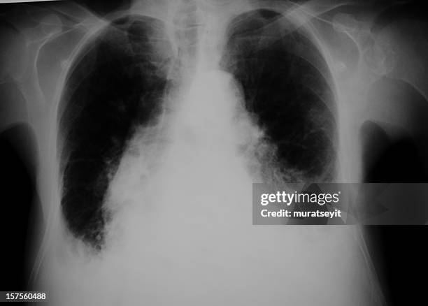 lung x-ray ein herz-fehler - lungenbläschen stock-fotos und bilder