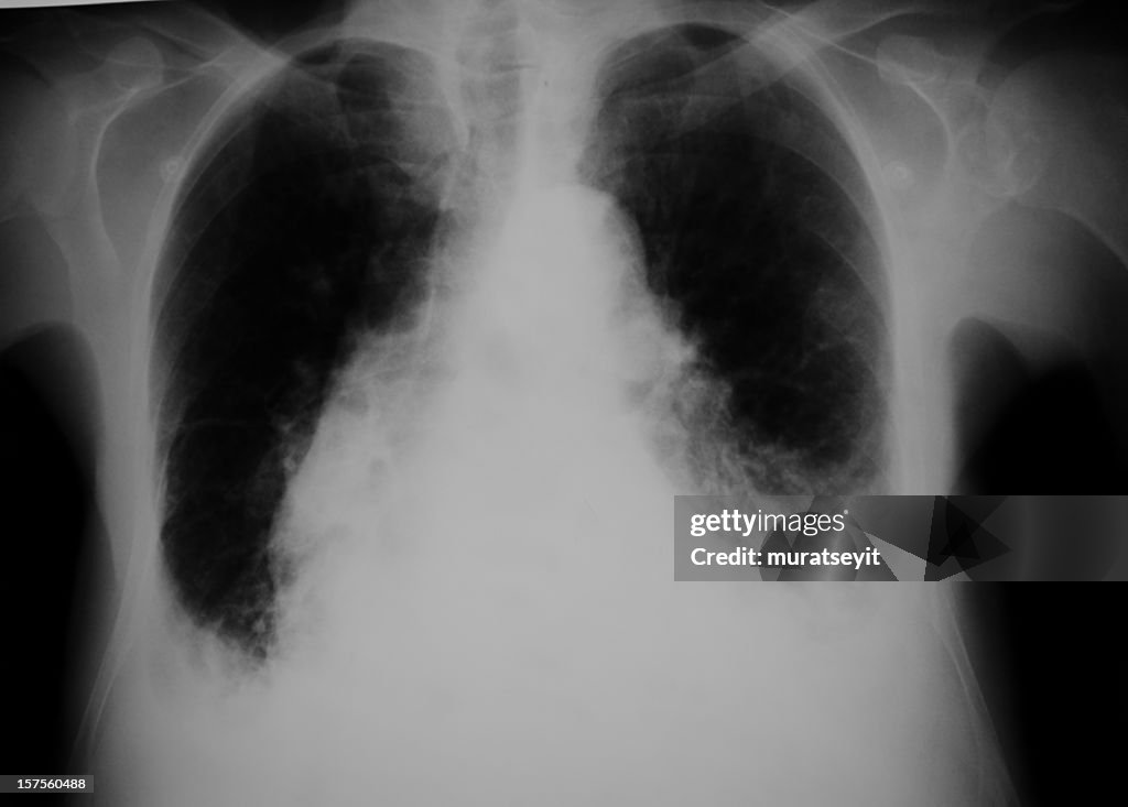 Lung x-ray of a heart failure