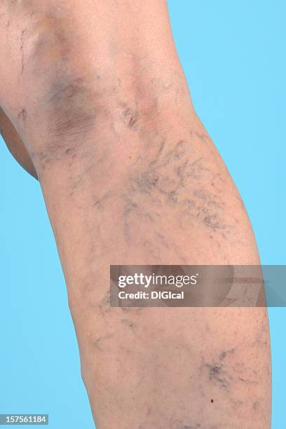 varicose veins on leg - varicose vein stock pictures, royalty-free photos & images