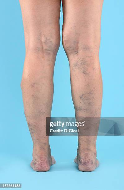 varicosa vien en las piernas y los pies - varices fotografías e imágenes de stock