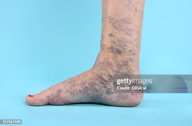 varicose vien zu fuß - krampfader stock-fotos und bilder