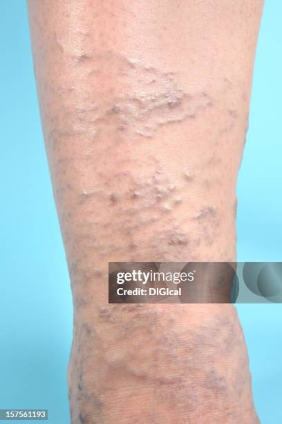 varicose veins on leg - varicose vein stock pictures, royalty-free photos & images