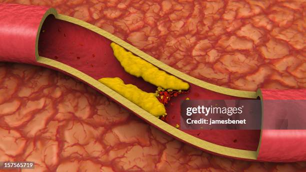 clogged artery (3d) - cholesterol stockfoto's en -beelden