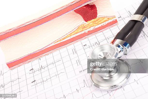 modèle de artériosclérose et stéthoscope et ecg - artériosclérose photos et images de collection