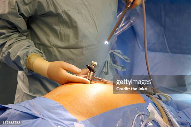 close up on medical staff prepping/conducting surgery - endoscope stock pictures, royalty-free photos & images
