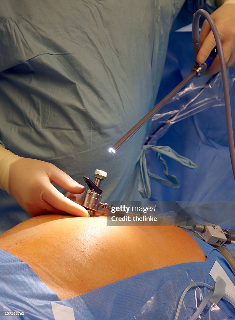 腹腔鏡下手術の準備