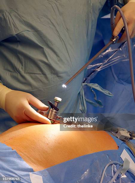 preparing a laparoscopic surgery - laparoscopic surgery stock pictures, royalty-free photos & images