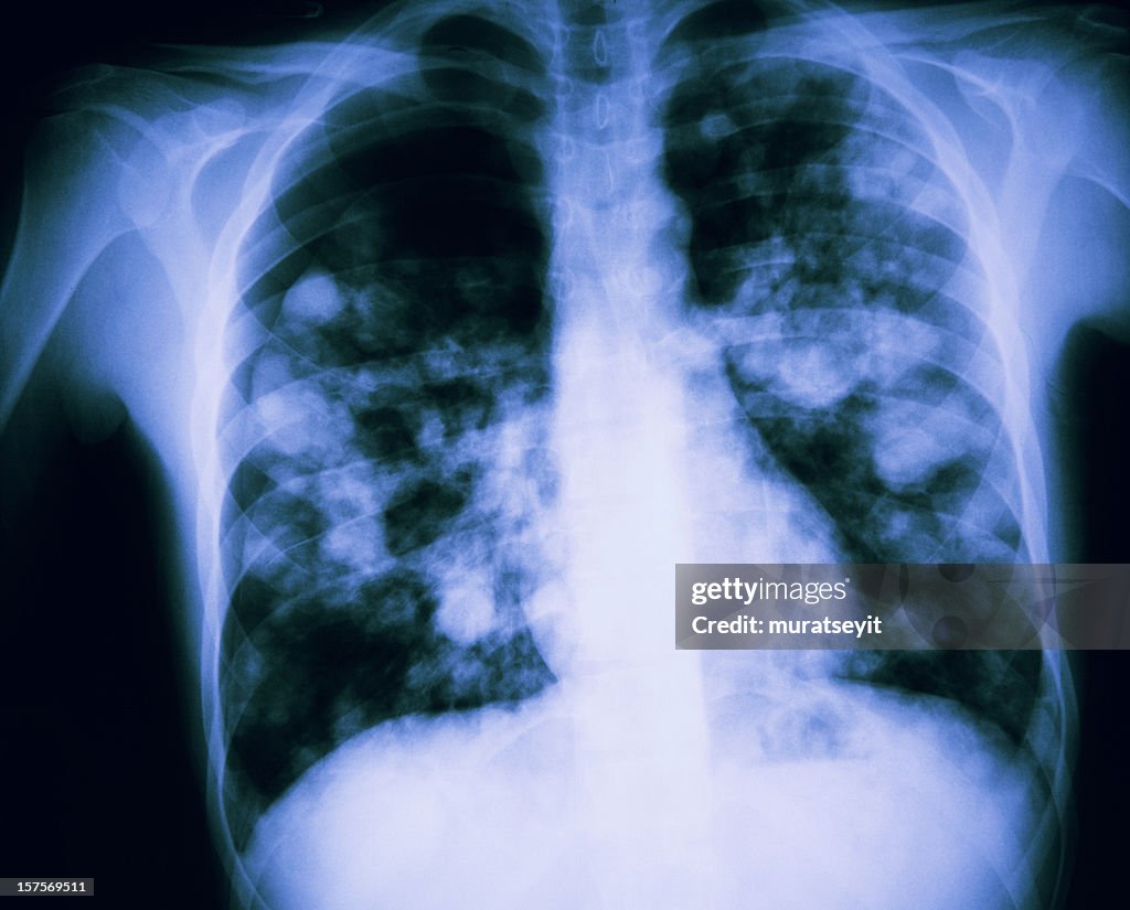Röntgenbild der lunge vermeintliche H7N9 Bird Grippe