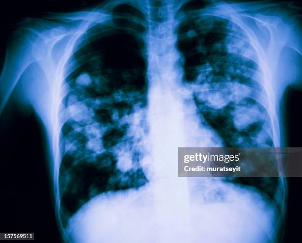 x-ray of a lunge suspected h7n9 bird flu - pulmonary edema xray stock pictures, royalty-free photos & images