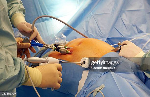 laparoscopic surgery - laparoscopic surgery stock pictures, royalty-free photos & images