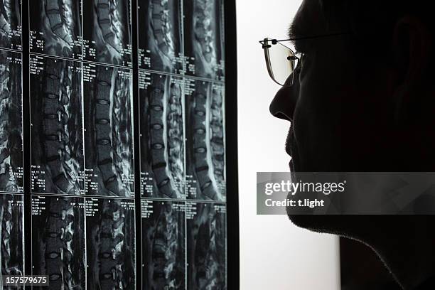 doctor analyzing mri scans of a person's vertebrae - orthopedic surgery stock pictures, royalty-free photos & images