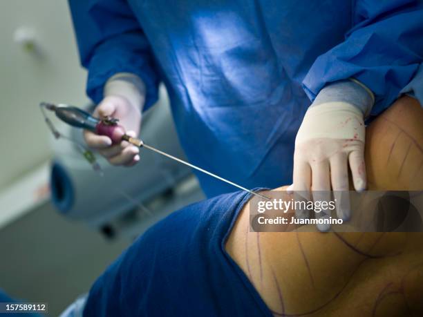 liposuction - plastische chirurgie stockfoto's en -beelden